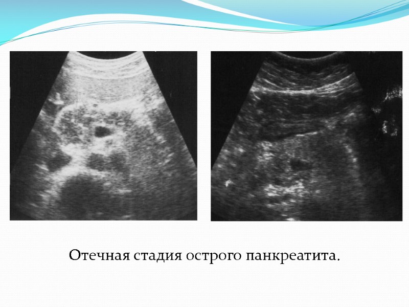 Отечная стадия острого панкреатита.